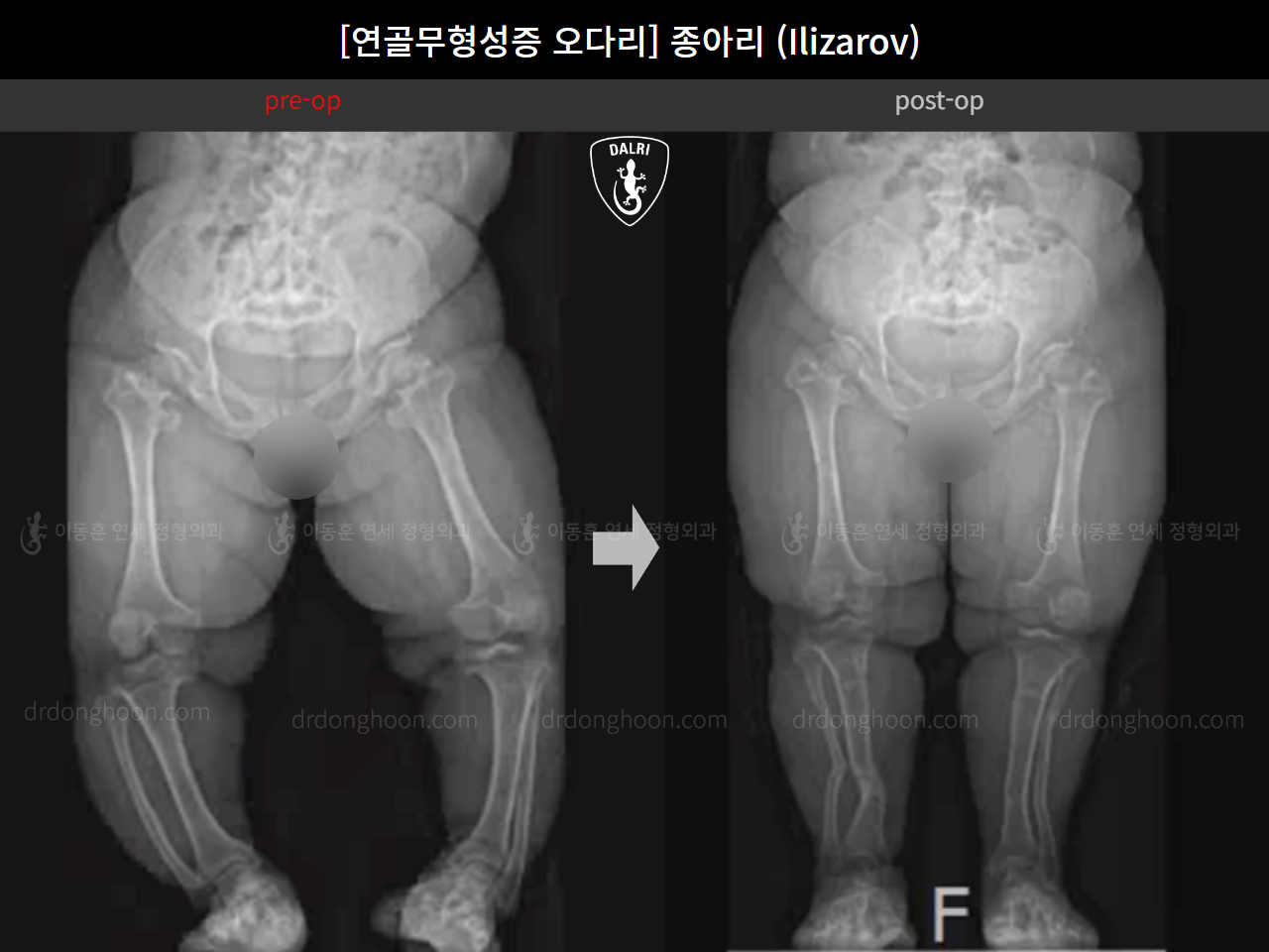 Before and after congenital condition, case 18077774, image 5, Dr. Donghoon institute (DALRI)