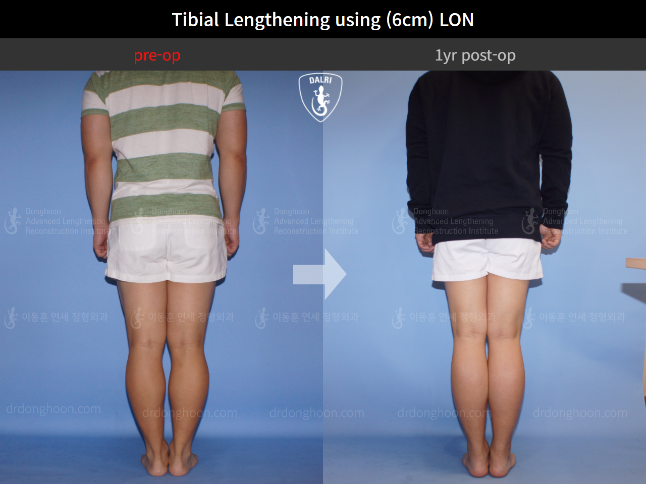 Before and after cll lon, case 4323461, image 2, Dr. Donghoon institute (DALRI)