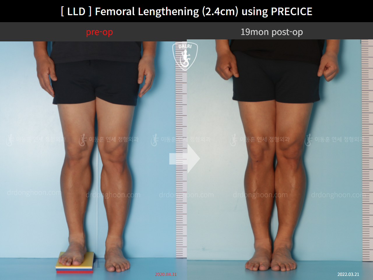 Before and after adult lld, case 10990486, image 5, Dr. Donghoon institute (DALRI)