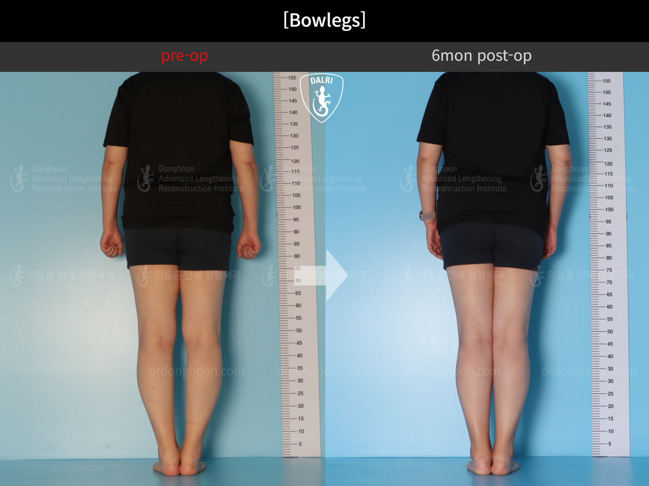 Before and after adult bowlegs, case 12396052, image 3, Dr. Donghoon institute (DALRI)