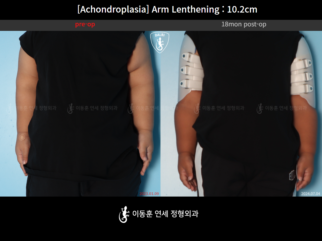 Before and after arm lengthening, case 38474065, image 4, Dr. Donghoon institute (DALRI)