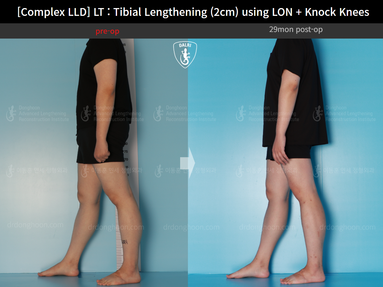 Before and after adult lld, case 16165477, image 3, Dr. Donghoon institute (DALRI)