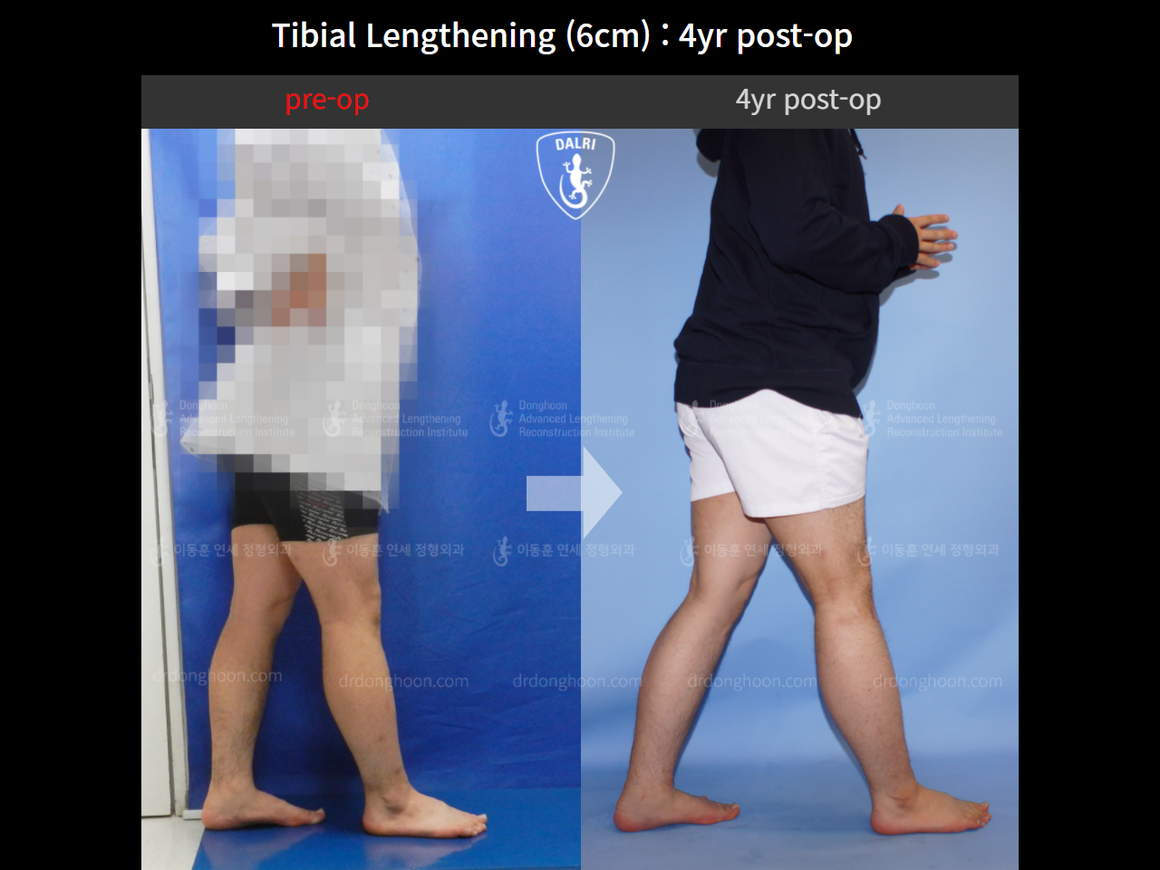 Before and after cll lon, case 10474212, image 3, Dr. Donghoon institute (DALRI)