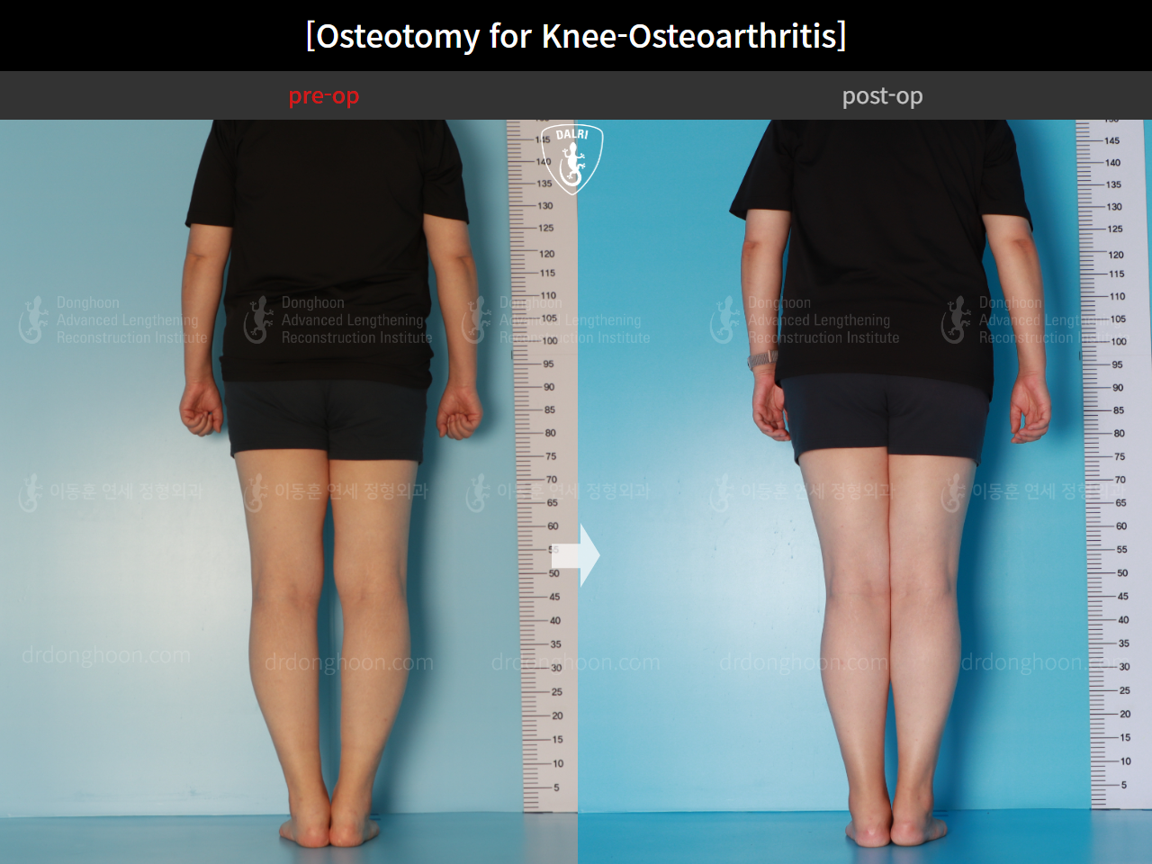 Before and after osteotomy for knee osteoarthritis, case 15944917, image 6, Dr. Donghoon institute (DALRI)