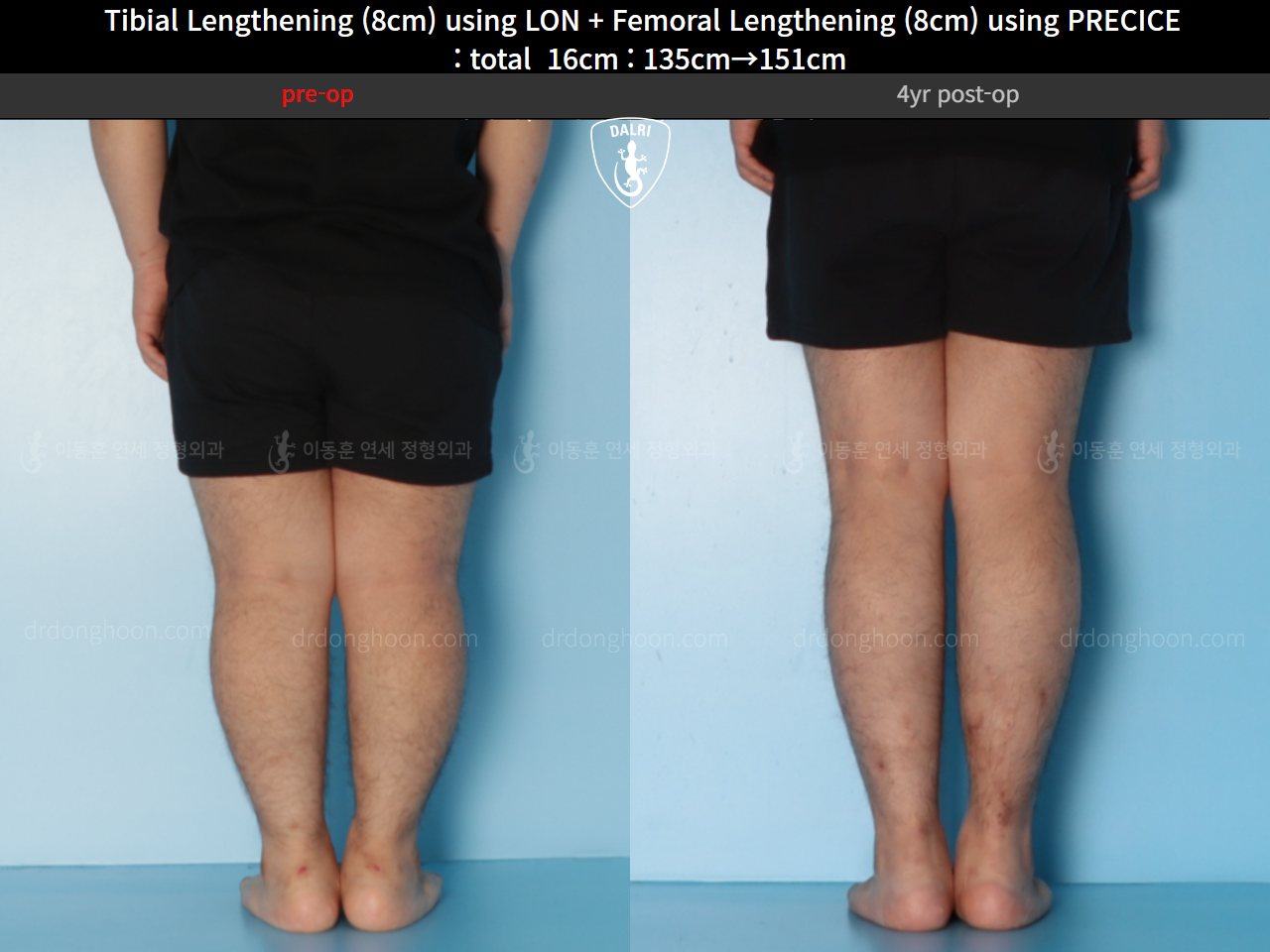 Before and after cll precice, case 128435842, image 7, Dr. Donghoon institute (DALRI)