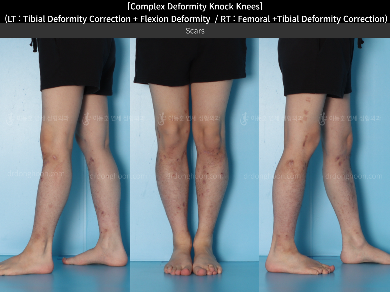 Before and after adult knock knees, case 14439339, image 9, Dr. Donghoon institute (DALRI)