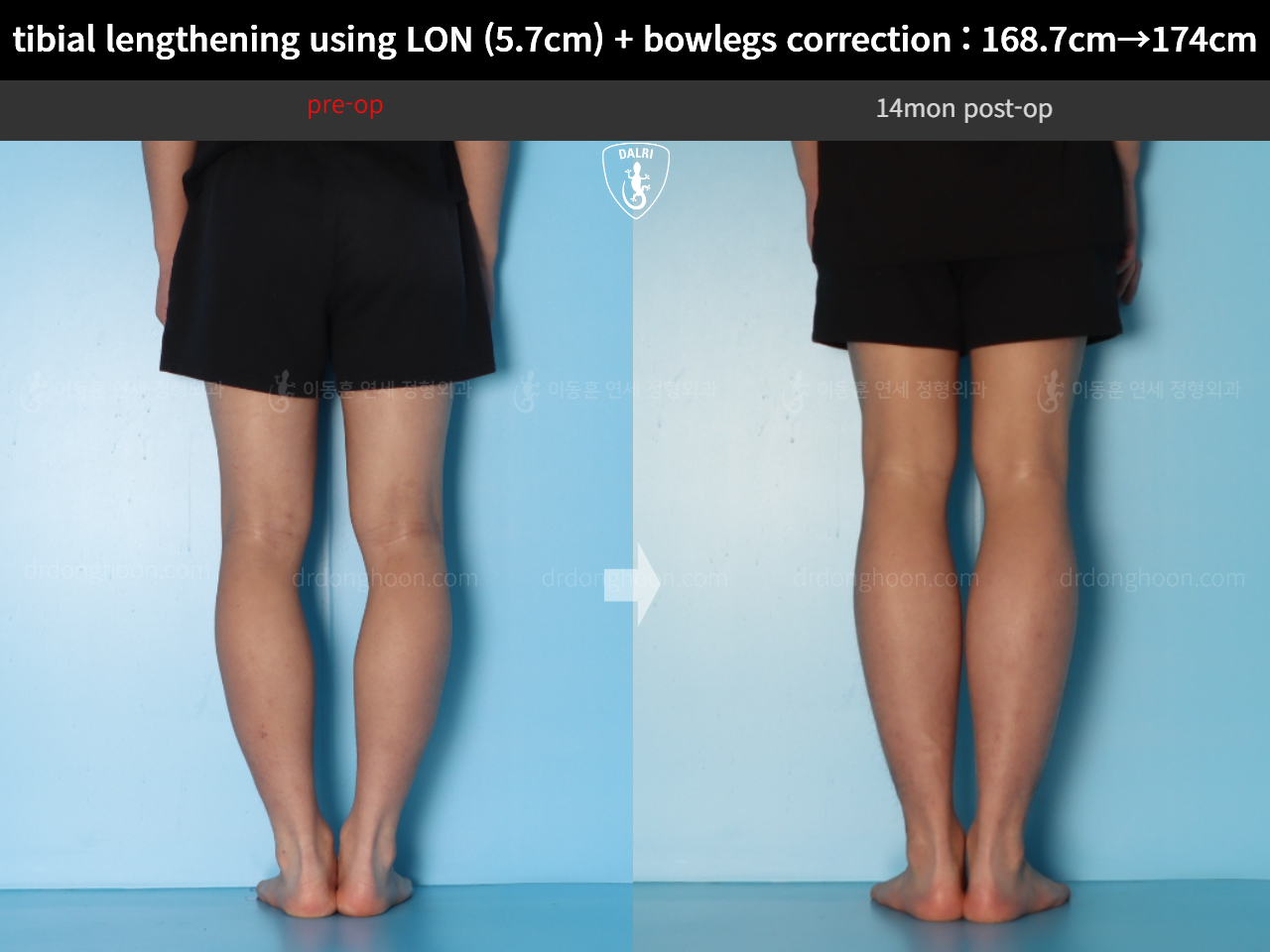 Before and after cll + deformity correction, case 18160780, image 8, Dr. Donghoon institute (DALRI)