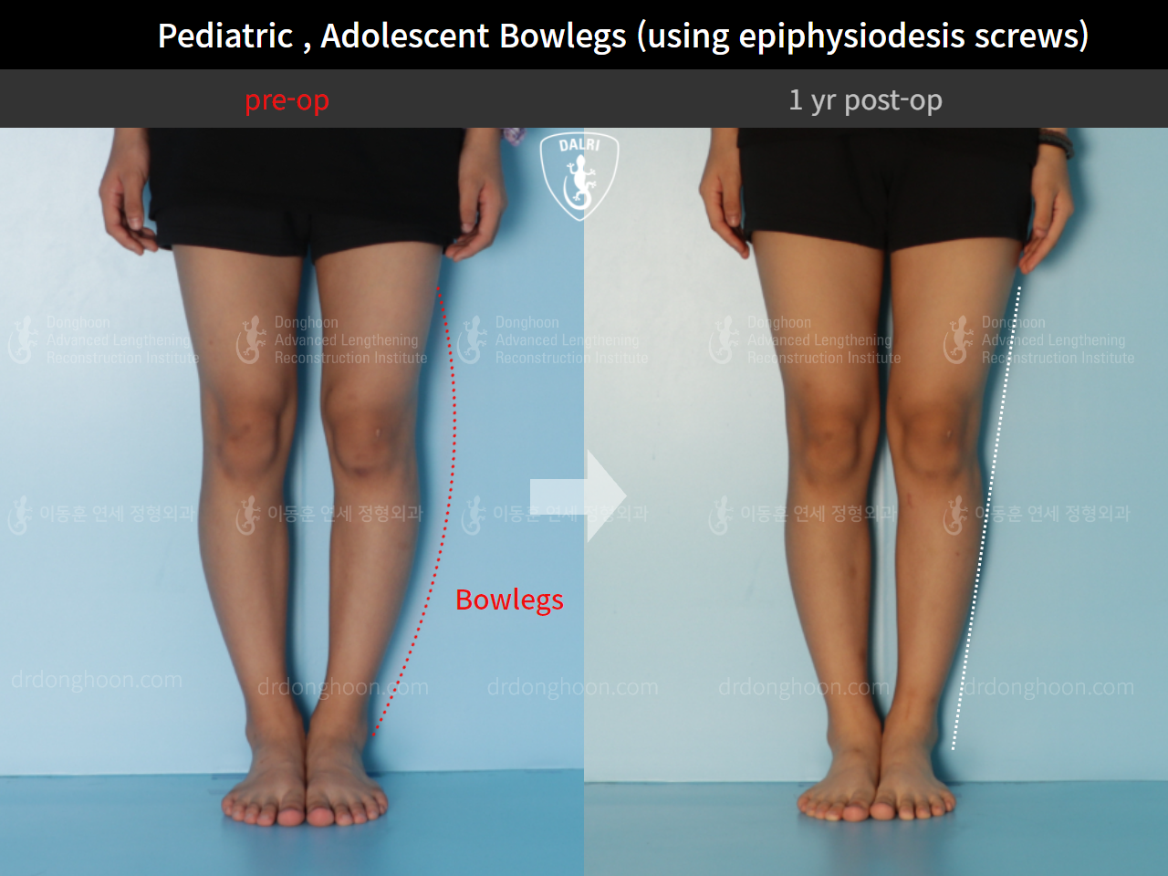 Before and after paediatric & adolescent bowlegs, case 9259159, image 2, Dr. Donghoon institute (DALRI)