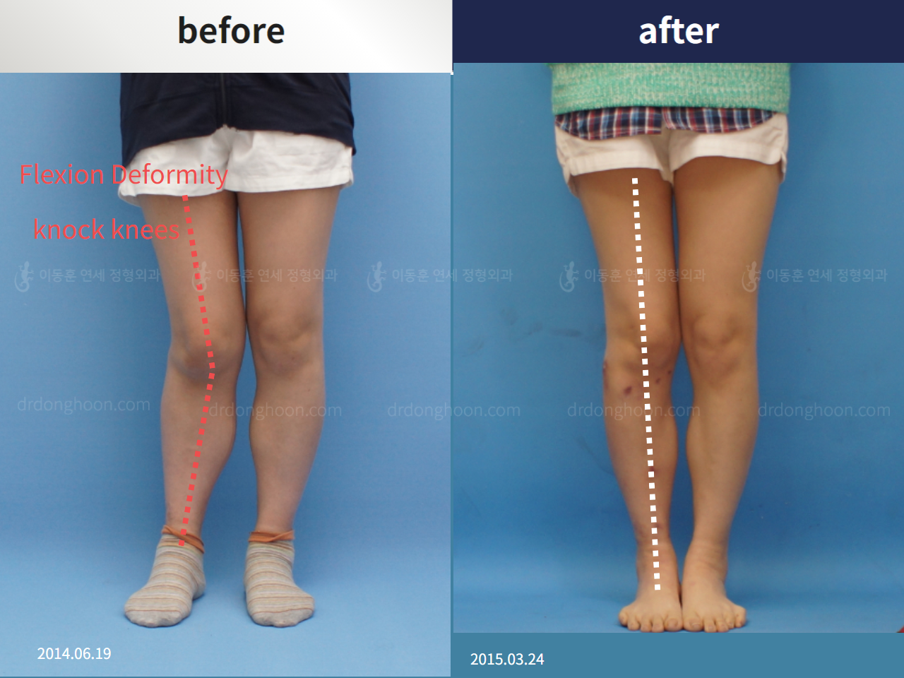 Before and after post-trauma deformity, case 4357134, image 1, Dr. Donghoon institute (DALRI)