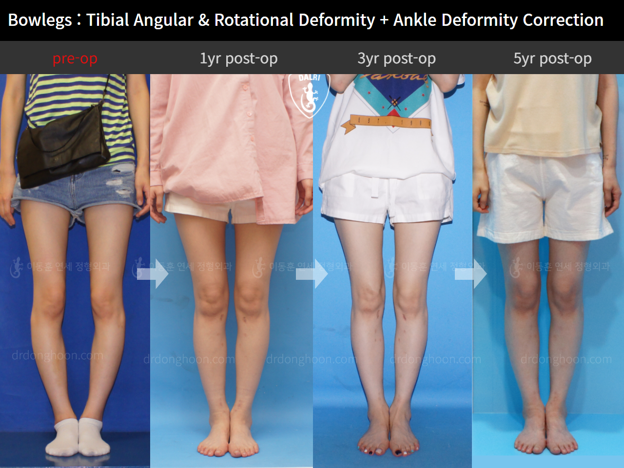 Before and after complex deformity, case 9471622, image 3, Dr. Donghoon institute (DALRI)