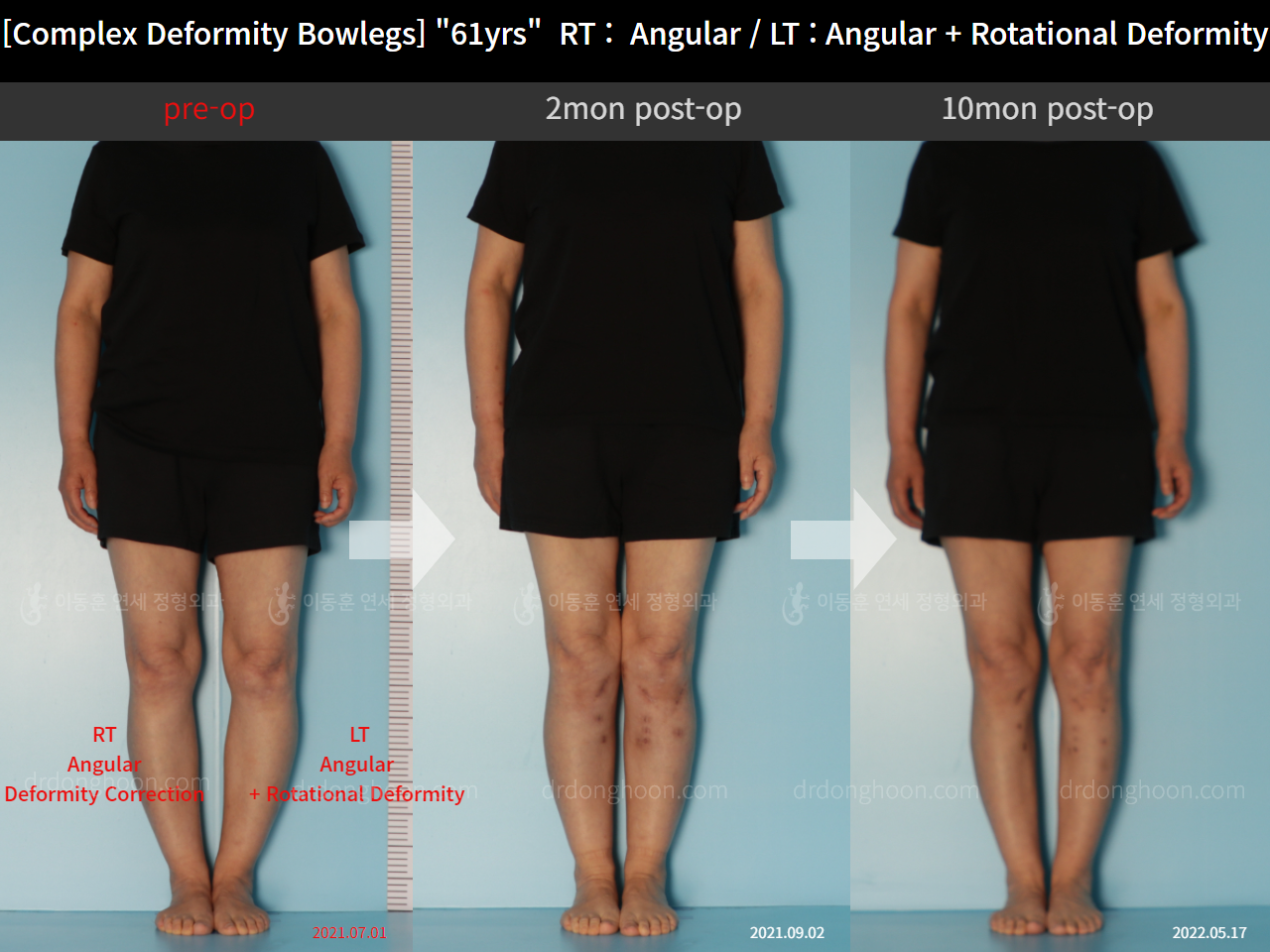 Before and after osteotomy for knee osteoarthritis, case 11576611, image 1, Dr. Donghoon institute (DALRI)
