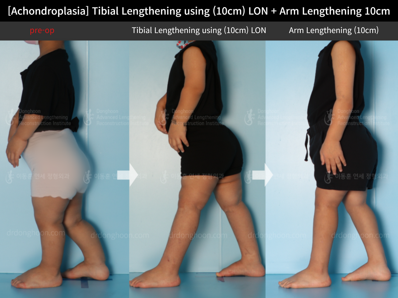 Before and after paediatric congenital condition, case 13864044, image 3, Dr. Donghoon institute (DALRI)