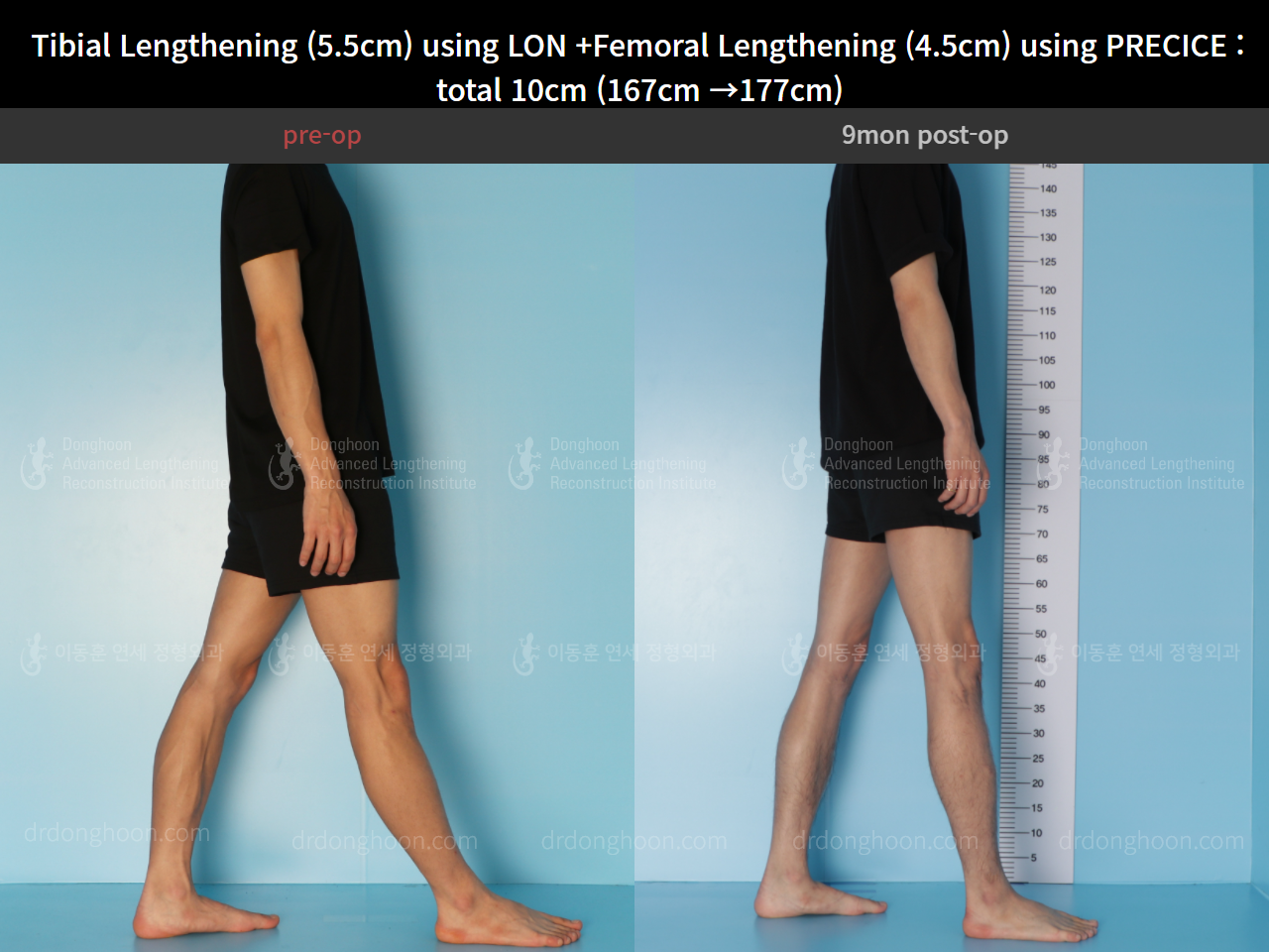 Before and after cll precice, case 4662233, image 4, Dr. Donghoon institute (DALRI)
