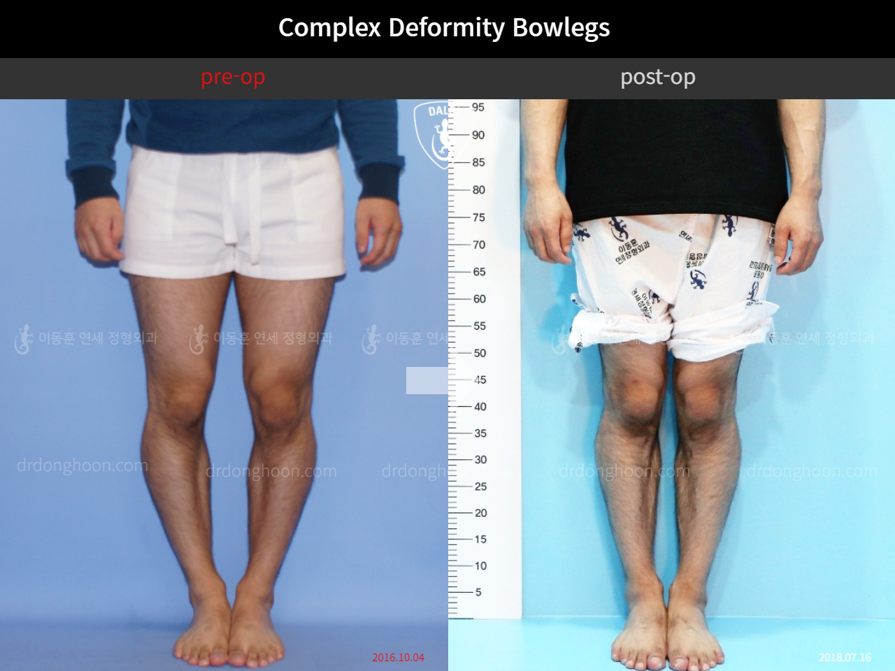 Before and after adult bowlegs, case 4311059, image 3, Dr. Donghoon institute (DALRI)