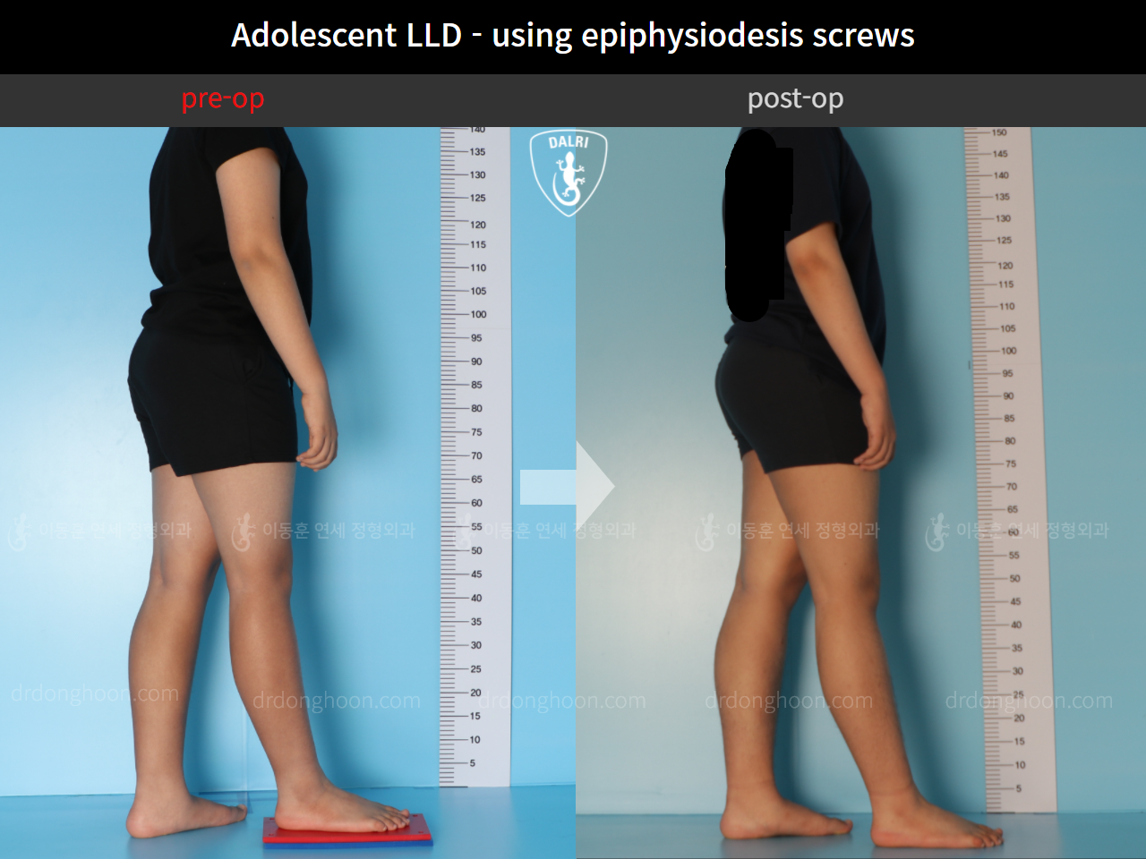 Before and after paediatric & adolescent lld, case 11472870, image 3, Dr. Donghoon institute (DALRI)