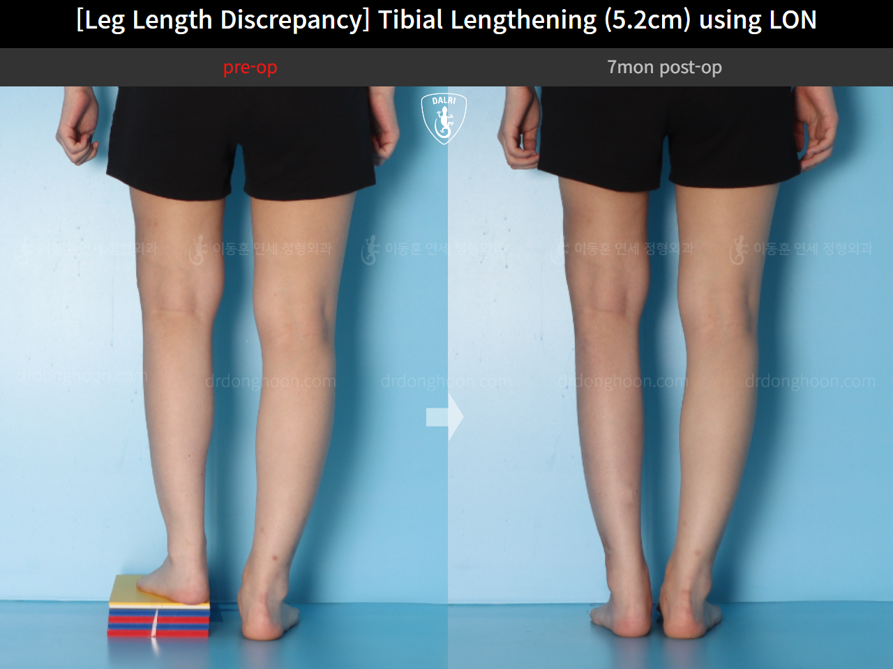 Before and after adult lld, case 16539955, image 5, Dr. Donghoon institute (DALRI)
