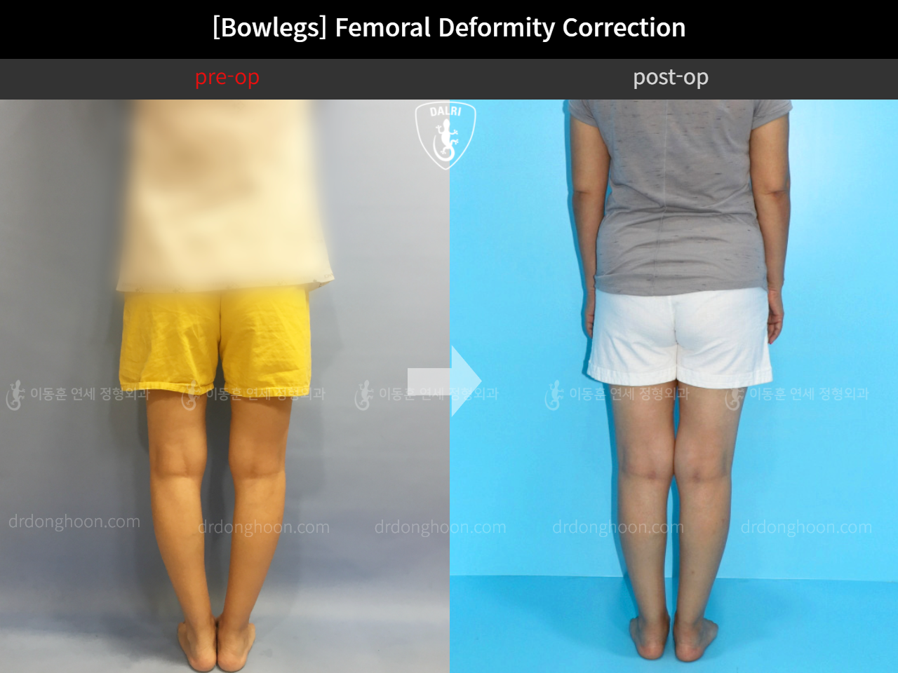 Before and after adult bowlegs, case 11379035, image 3, Dr. Donghoon institute (DALRI)
