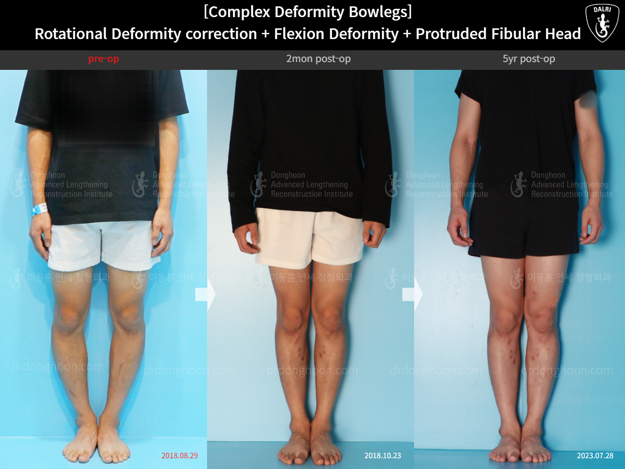 Before and after adult bowlegs, case 15944746, image 1, Dr. Donghoon institute (DALRI)