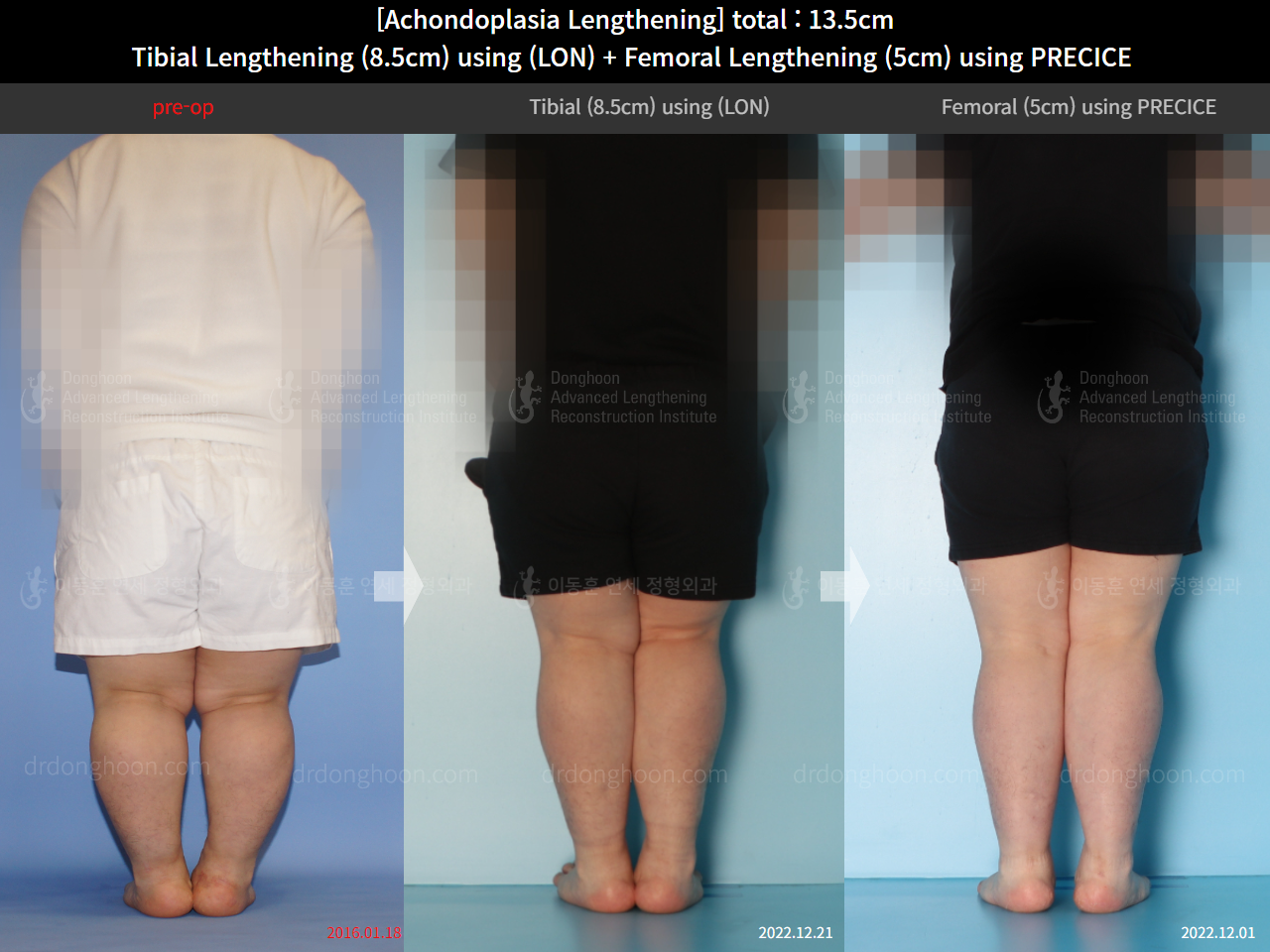 Before and after congenital condition, case 14993507, image 2, Dr. Donghoon institute (DALRI)