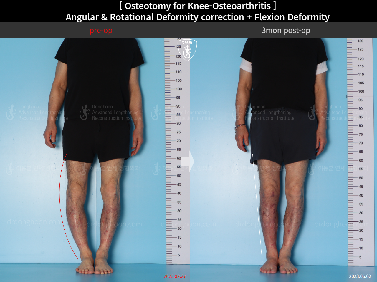 Before and after osteotomy for knee osteoarthritis, case 15362950, image 1, Dr. Donghoon institute (DALRI)