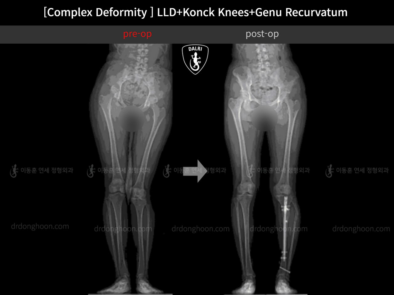 Before and after adult lld, case 12333631, image 9, Dr. Donghoon institute (DALRI)