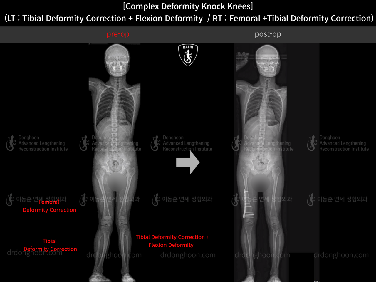 Before and after flexion deformity, case 14439359, image 5, Dr. Donghoon institute (DALRI)