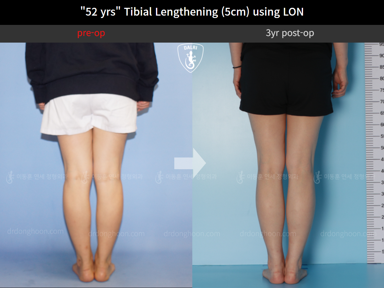 Before and after cll lon, case 9977769, image 6, Dr. Donghoon institute (DALRI)