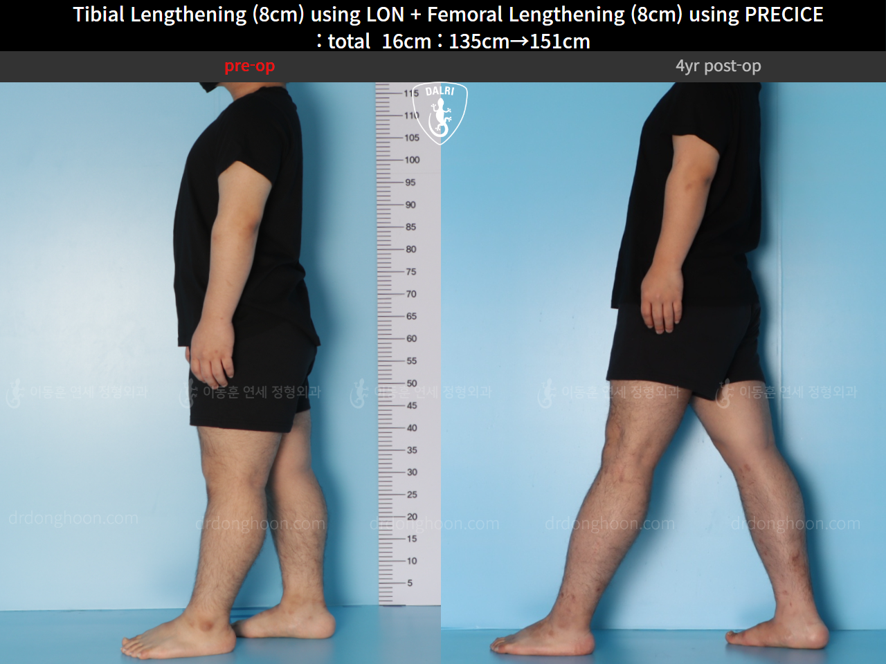 Before and after cll precice, case 128435842, image 3, Dr. Donghoon institute (DALRI)
