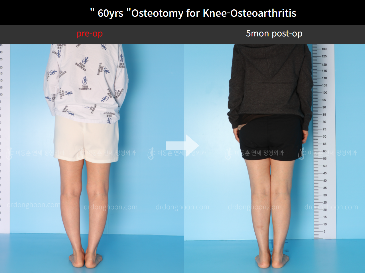 Before and after osteotomy for knee osteoarthritis, case 4586357, image 2, Dr. Donghoon institute (DALRI)