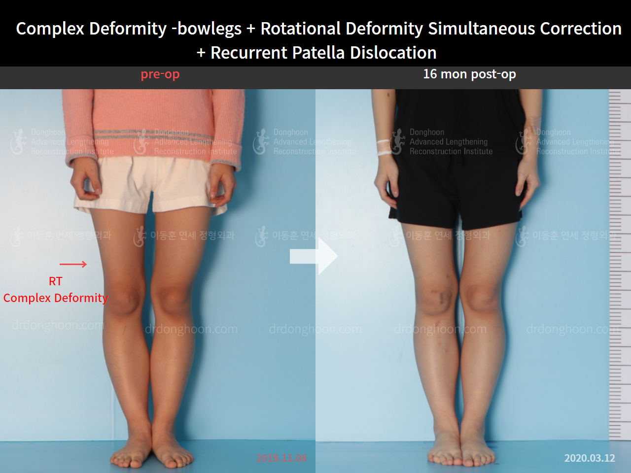 Before and after recurrent patella dislocation, case 8580605, image 5, Dr. Donghoon institute (DALRI)