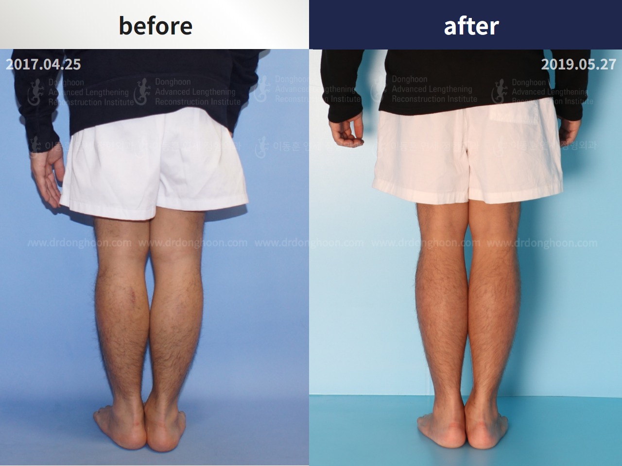 Before and after congenital condition, case 4300006, image 2, Dr. Donghoon institute (DALRI)