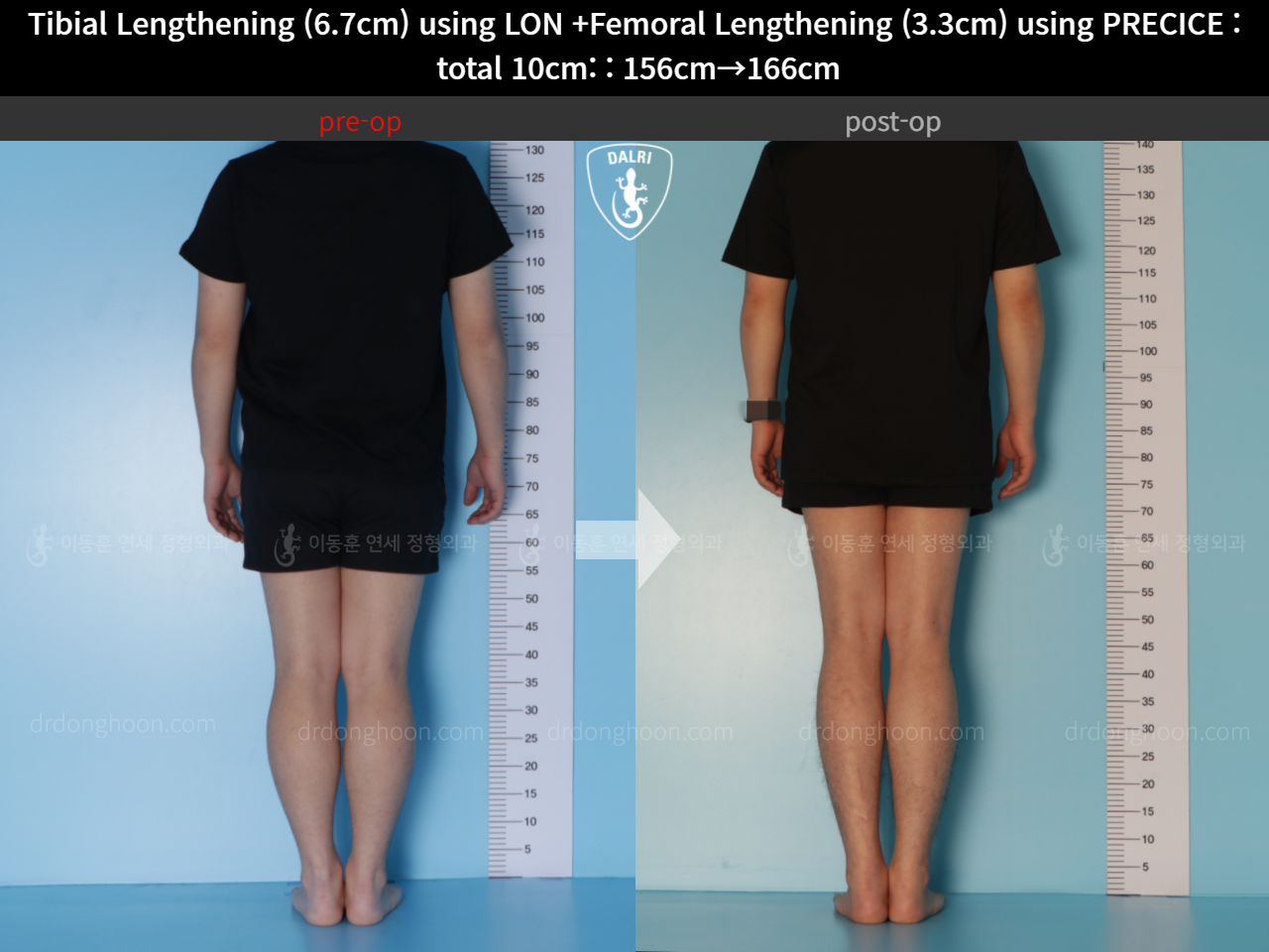 Before and after cll lon, case 11044268, image 2, Dr. Donghoon institute (DALRI)