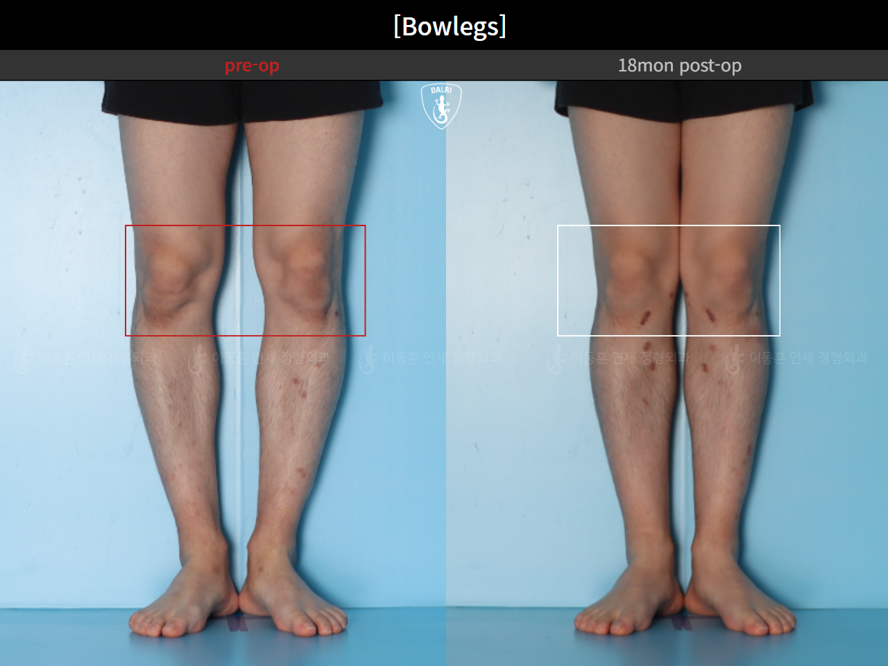 Before and after adult bowlegs, case 94769040, image 8, Dr. Donghoon institute (DALRI)