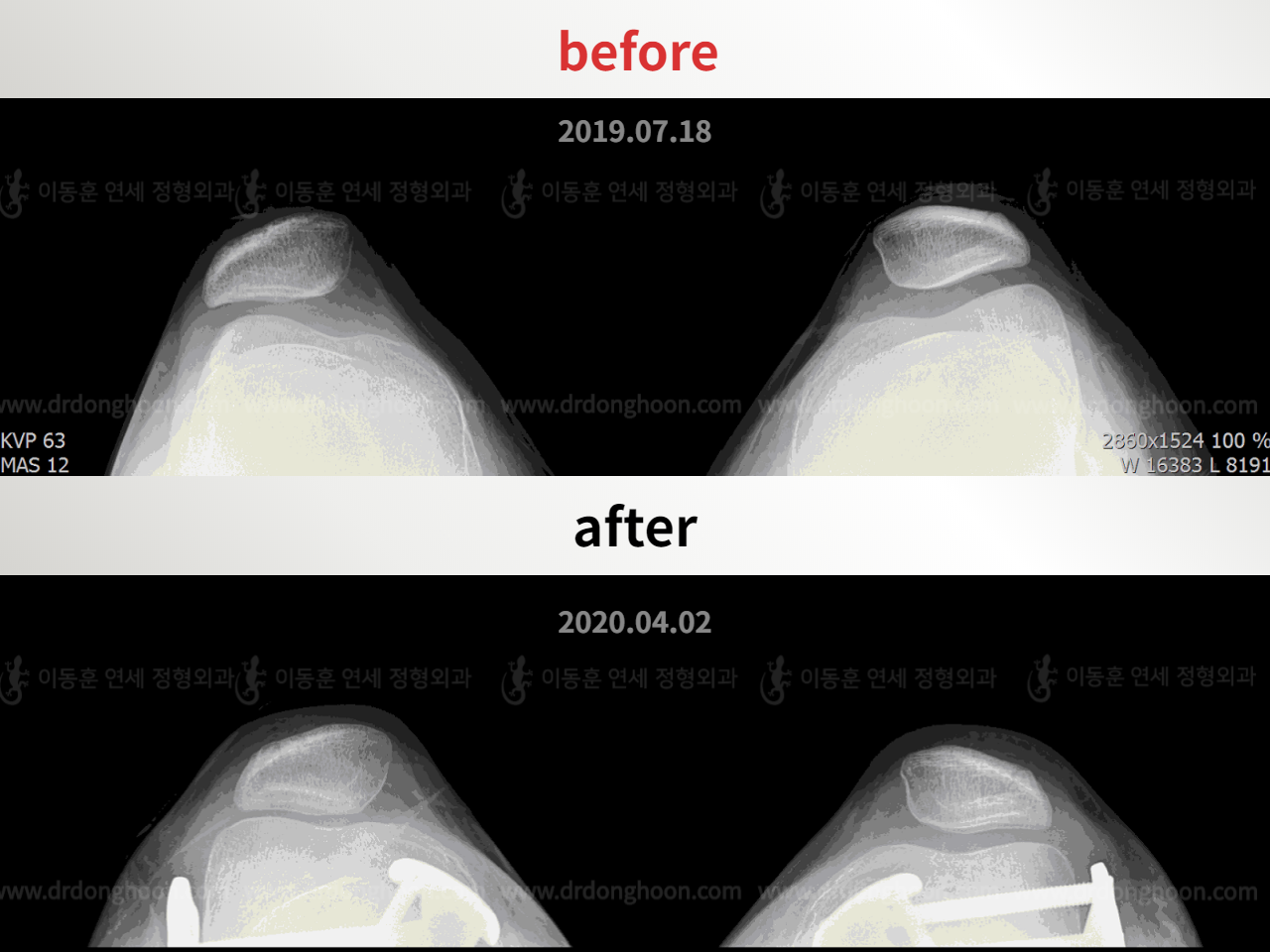 Before and after adult bowlegs, case 5395875, image 4, Dr. Donghoon institute (DALRI)