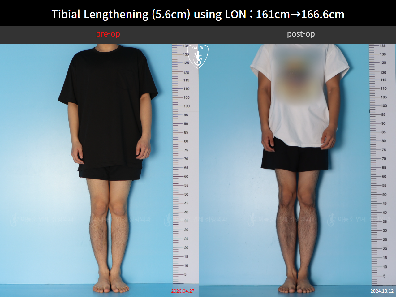 Before and after cll lon, case 126542150, image 1, Dr. Donghoon institute (DALRI)