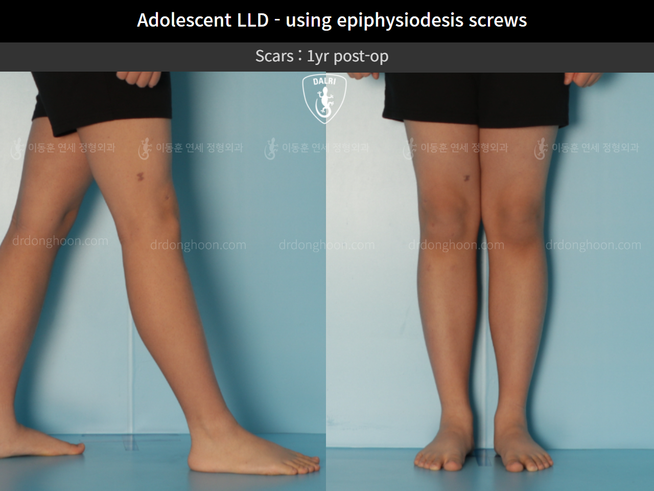 Before and after paediatric & adolescent lld, case 10291768, image 5, Dr. Donghoon institute (DALRI)