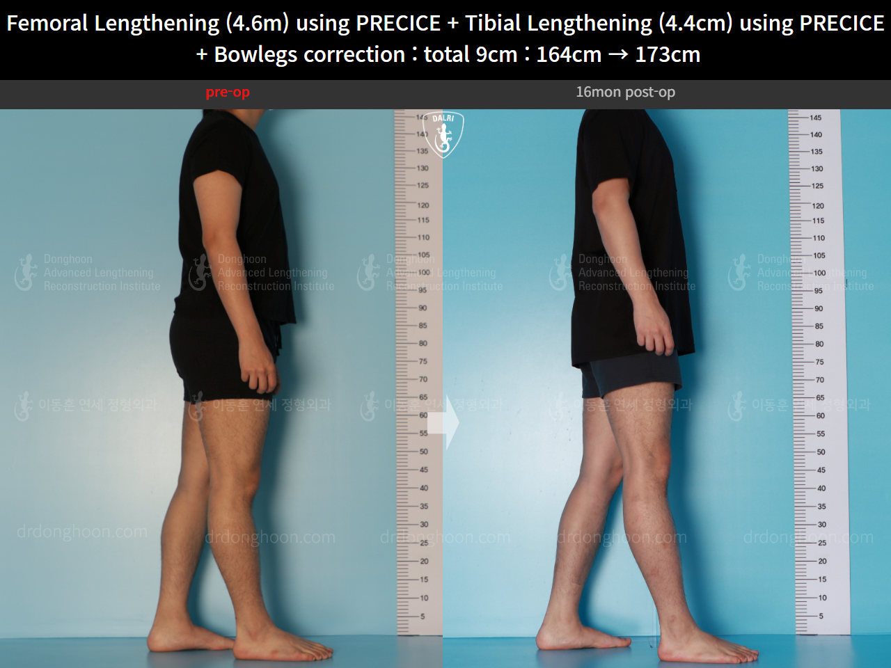 Before and after cll + deformity correction, case 16697522, image 5, Dr. Donghoon institute (DALRI)