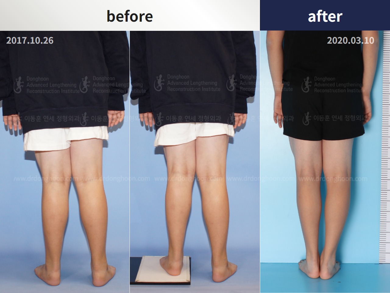 Before and after paediatric & adolescent knock knees, case 4310935, image 3, Dr. Donghoon institute (DALRI)