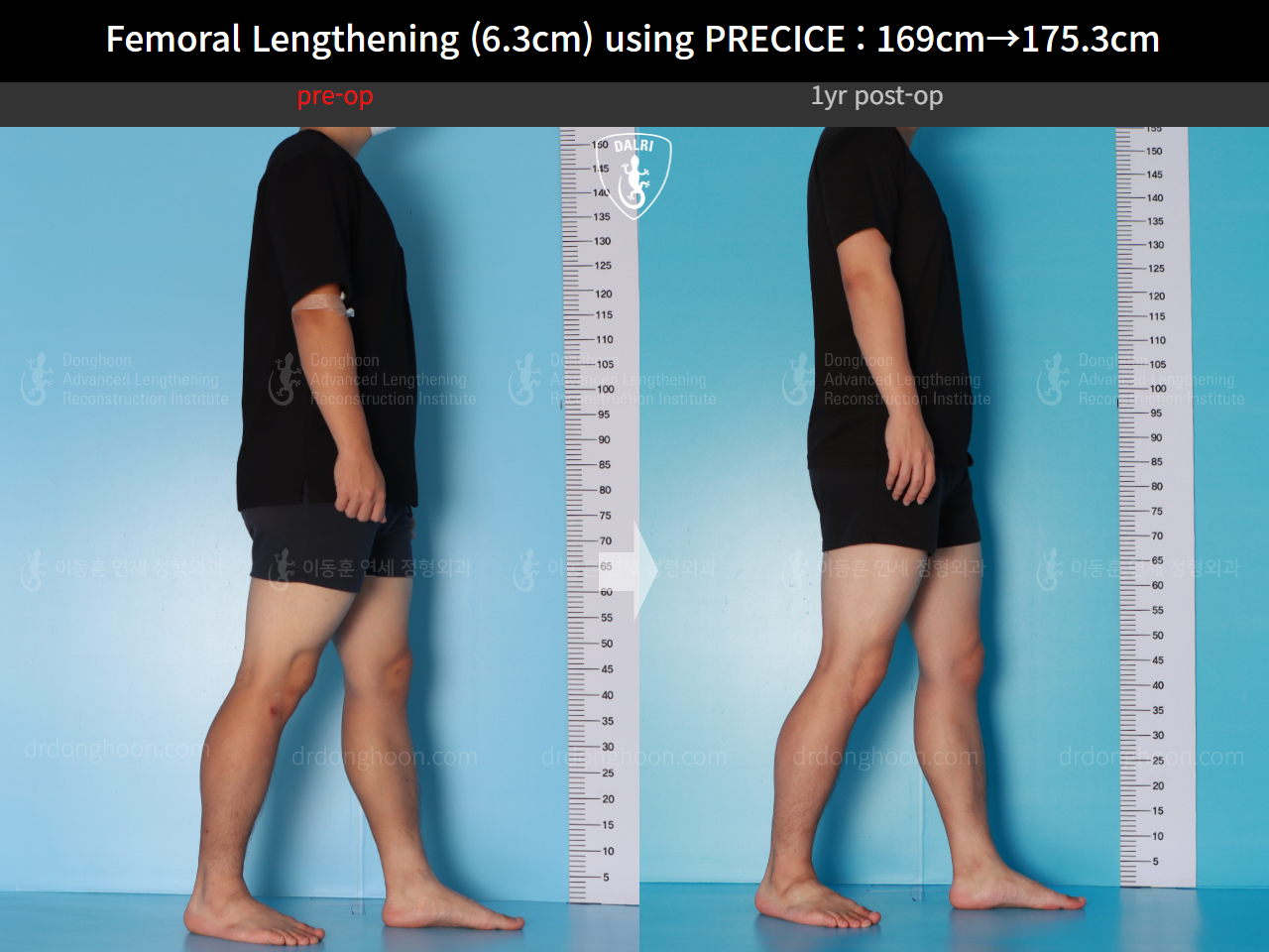 Before and after cll precice, case 16070058, image 6, Dr. Donghoon institute (DALRI)