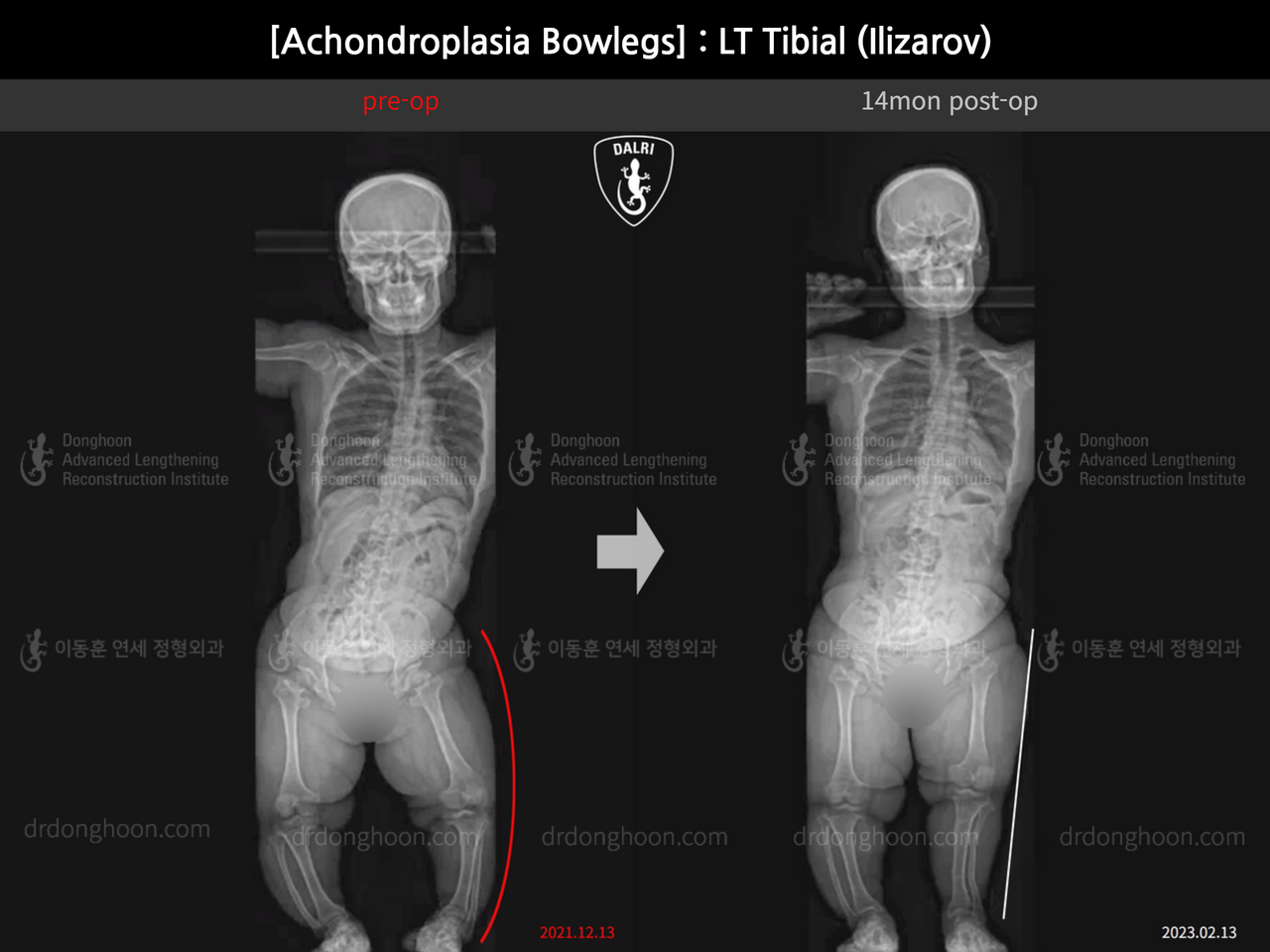 Before and after adult bowlegs, case 14296179, image 6, Dr. Donghoon institute (DALRI)
