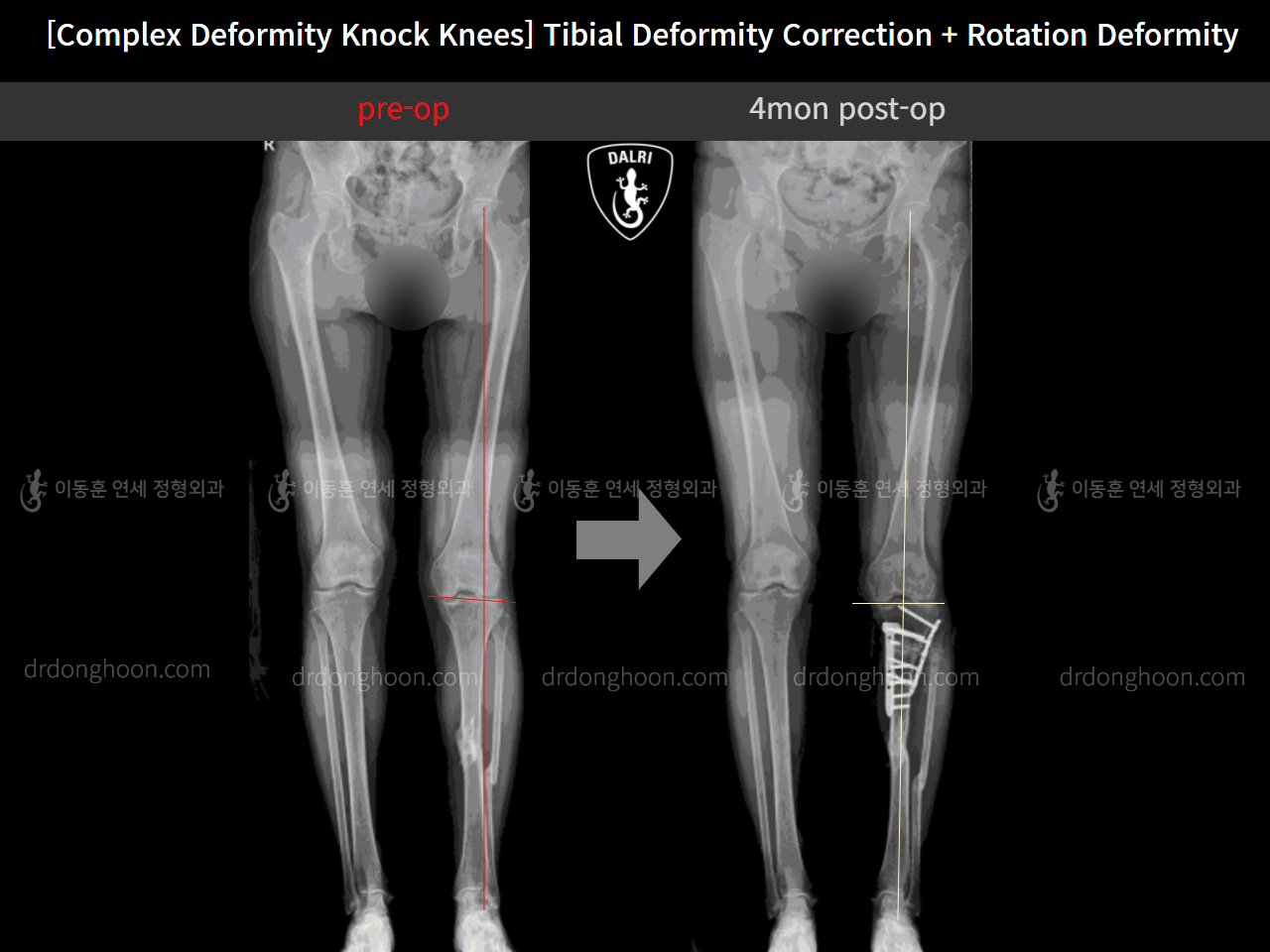 Before and after adult knock knees, case 11747832, image 5, Dr. Donghoon institute (DALRI)