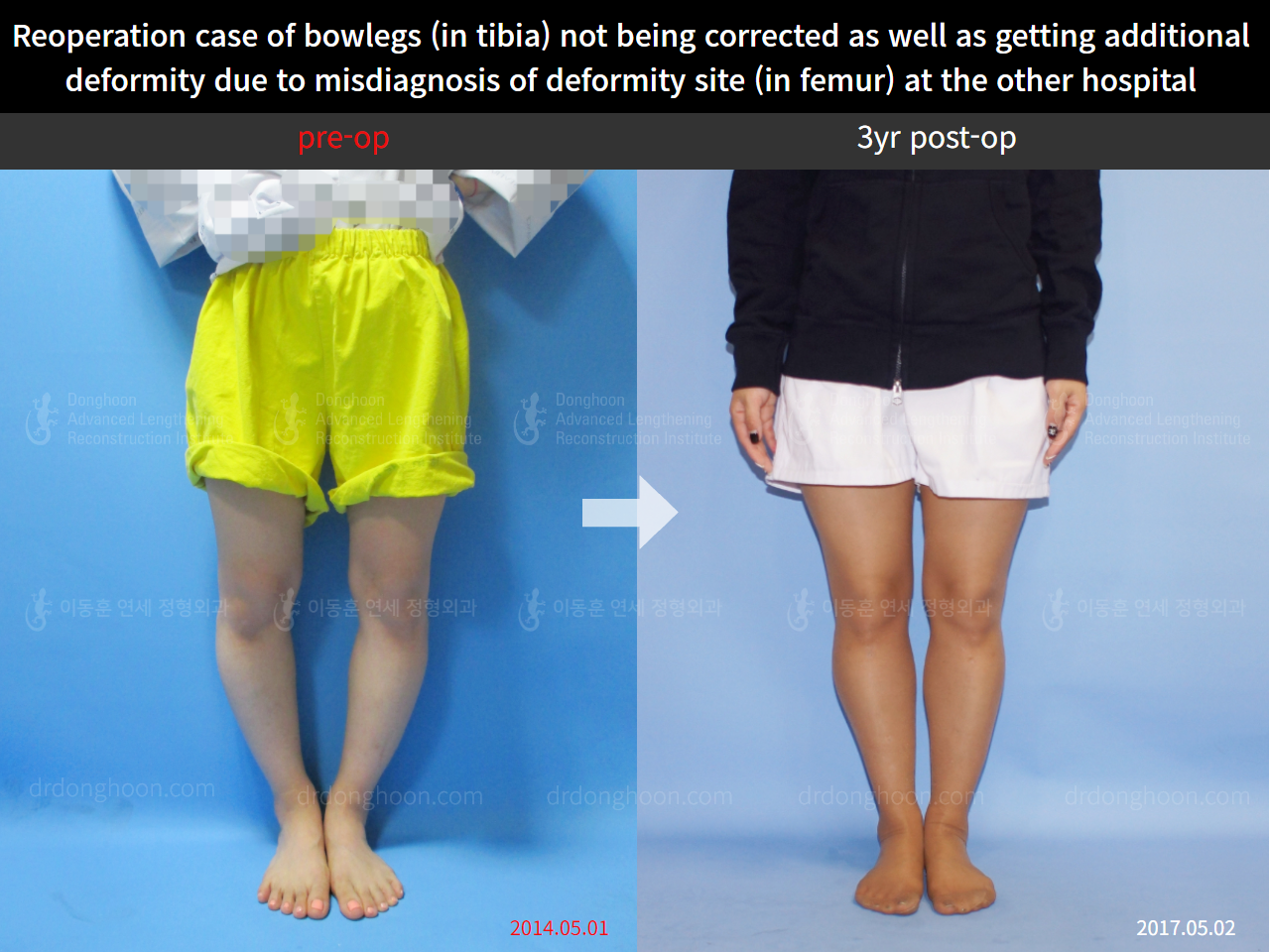 Before and after reoperation after deformity correction, case 5306623, image 2, Dr. Donghoon institute (DALRI)