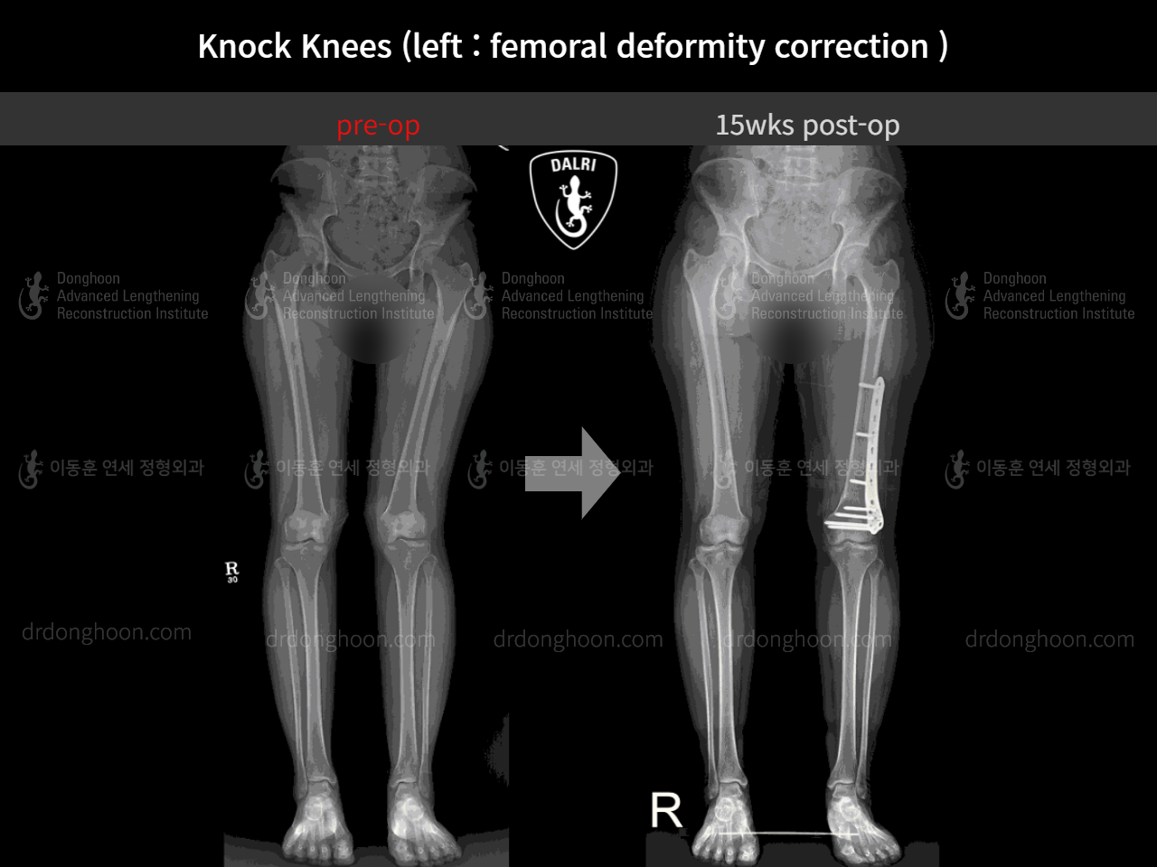Before and after adult knock knees, case 8259194, image 4, Dr. Donghoon institute (DALRI)