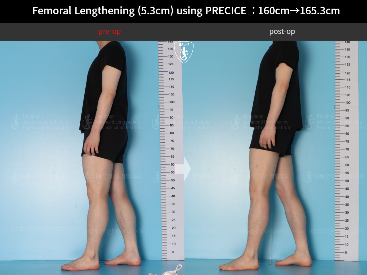 Before and after cll precice, case 18250566, image 5, Dr. Donghoon institute (DALRI)