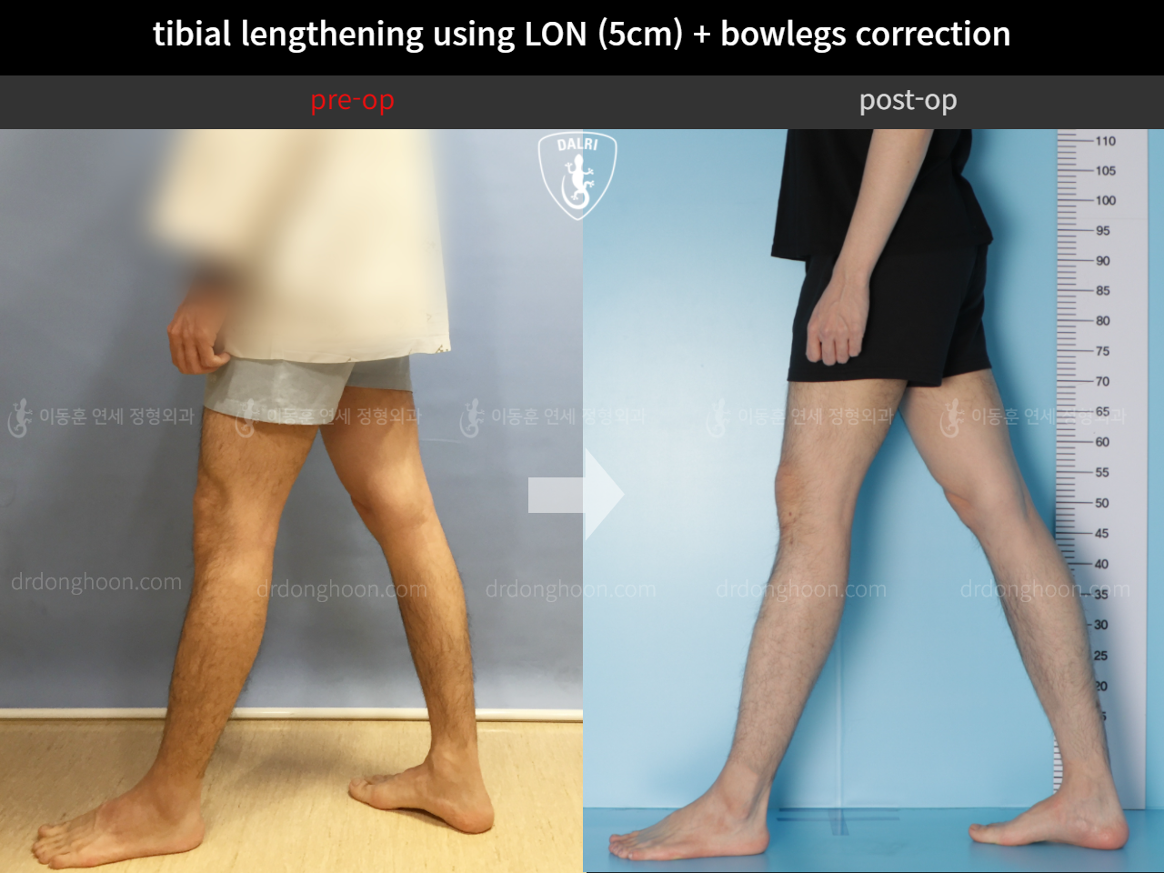 Before and after cll + deformity correction, case 4323130, image 8, Dr. Donghoon institute (DALRI)