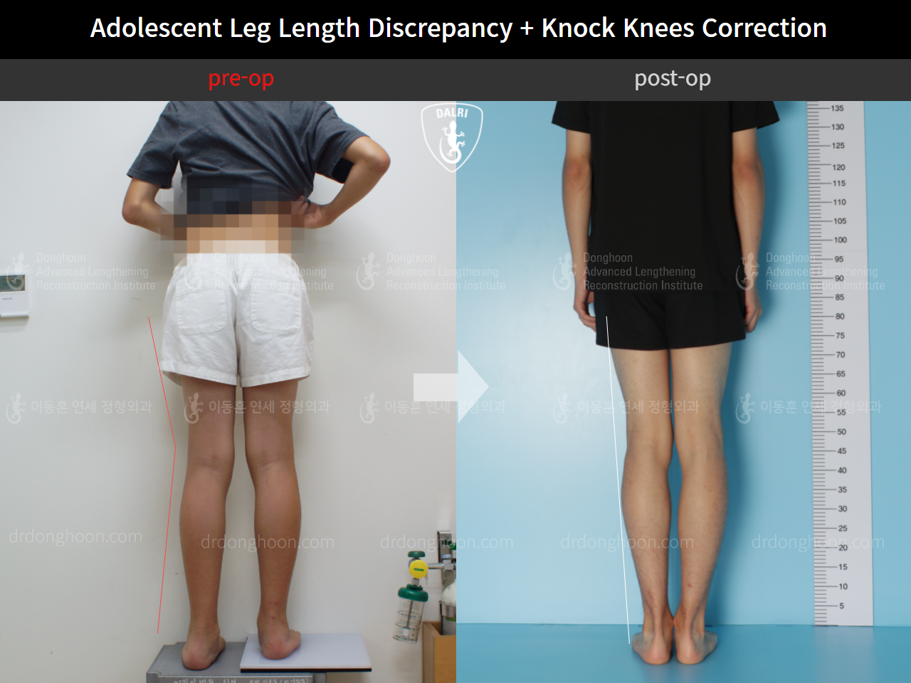 Before and after paediatric & adolescent lld, case 4585692, image 2, Dr. Donghoon institute (DALRI)