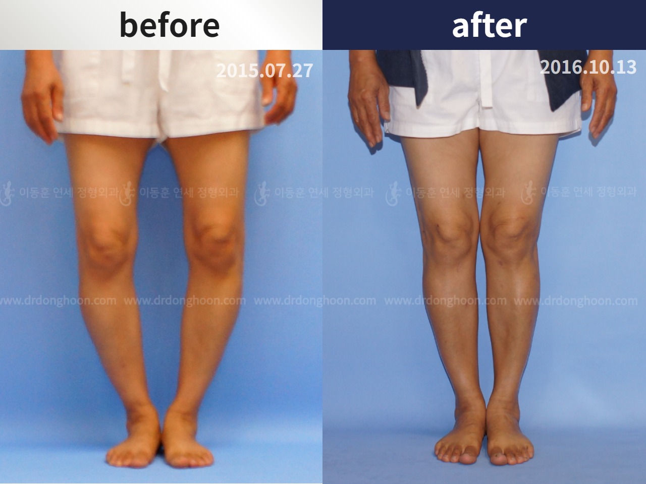 Before and after osteotomy for knee osteoarthritis, case 4306457, image 1, Dr. Donghoon institute (DALRI)