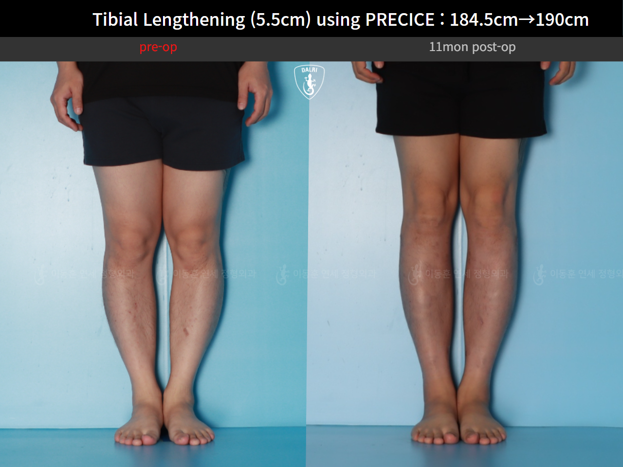 Before and after cll precice, case 125279355, image 7, Dr. Donghoon institute (DALRI)