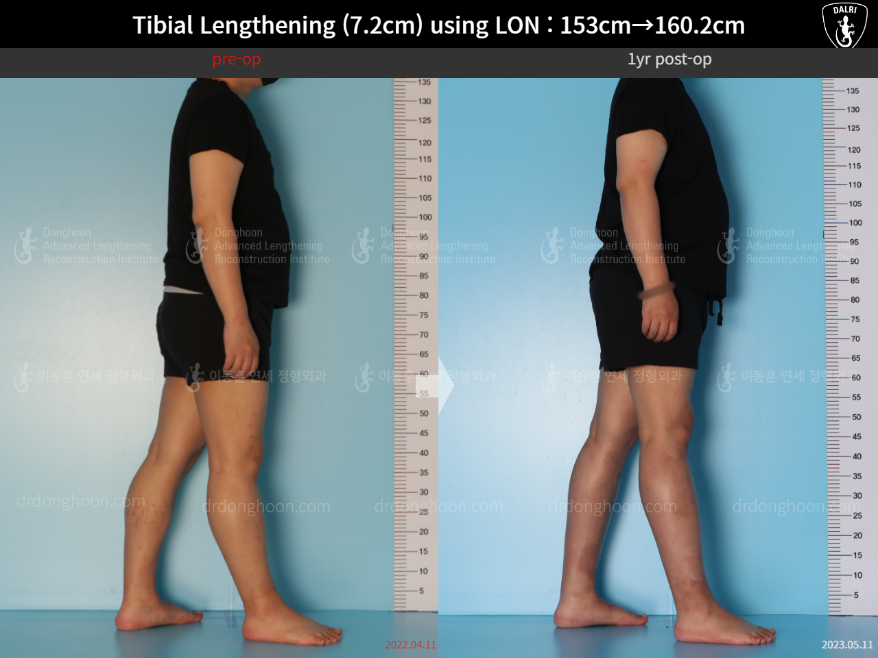 Before and after cll lon, case 15150707, image 3, Dr. Donghoon institute (DALRI)