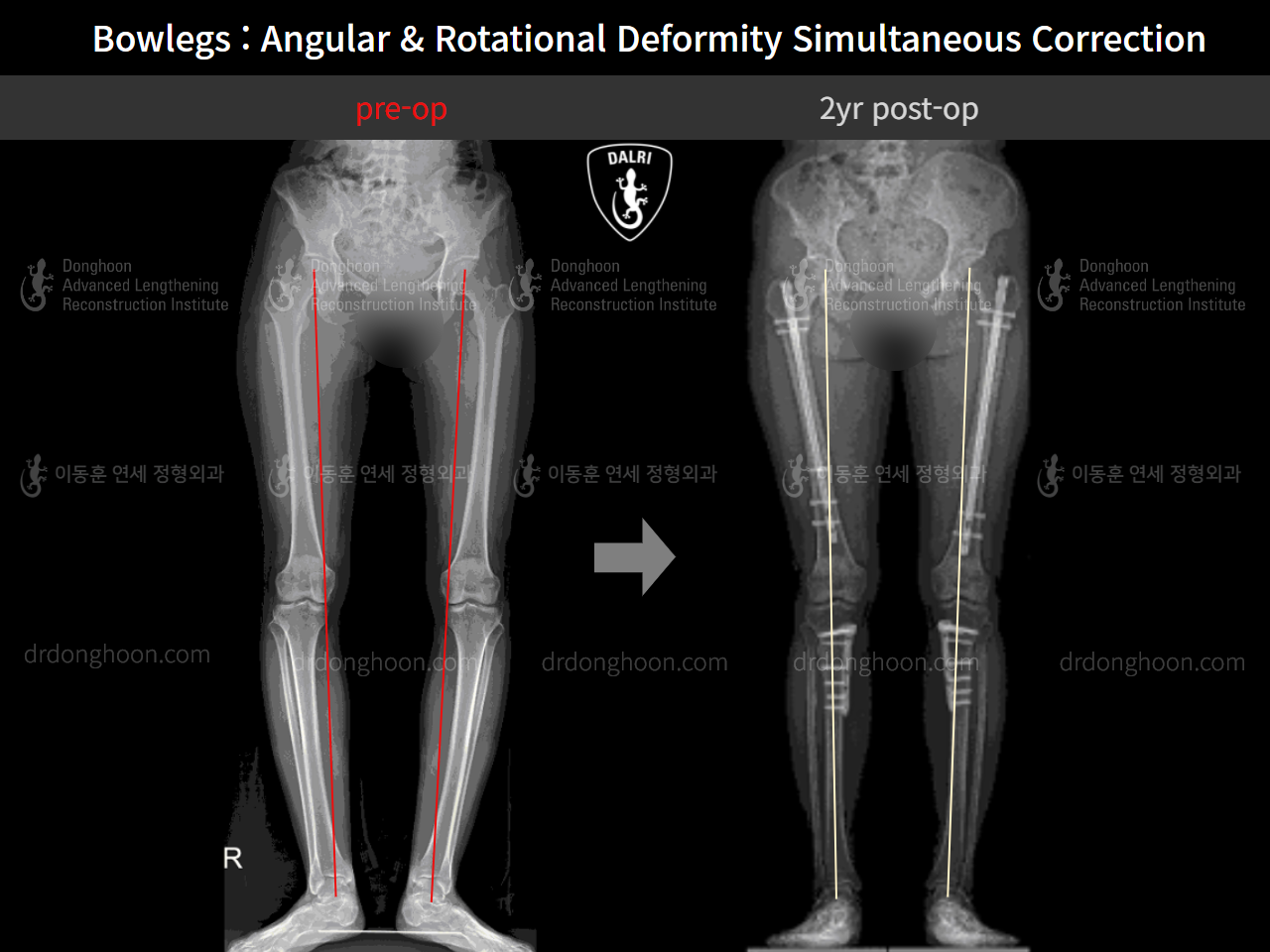 Before and after adult bowlegs, case 4311375, image 9, Dr. Donghoon institute (DALRI)